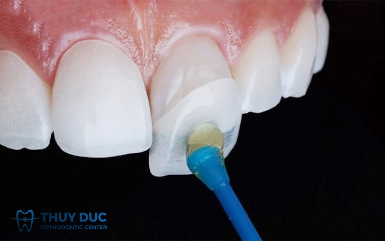 Dán sứ Veneer 1 Dán sứ Veneer 1