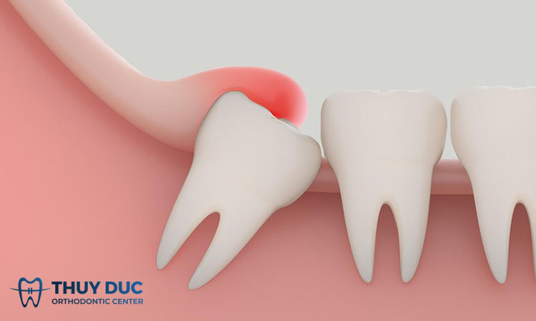1. Dấu hiệu nhận biết răng khôn mọc lệch 1 1. Dấu hiệu nhận biết răng khôn mọc lệch 1