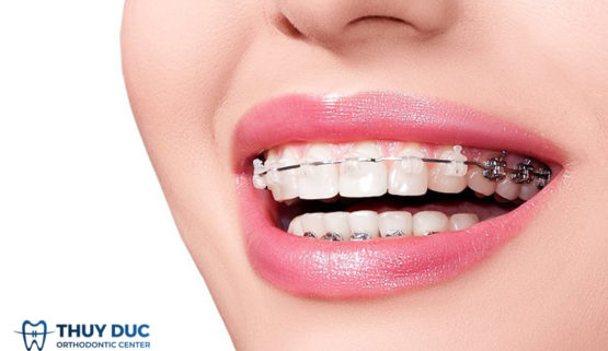 Cách gắn dây cung vào mắc cài tại nhà an toàn nhất