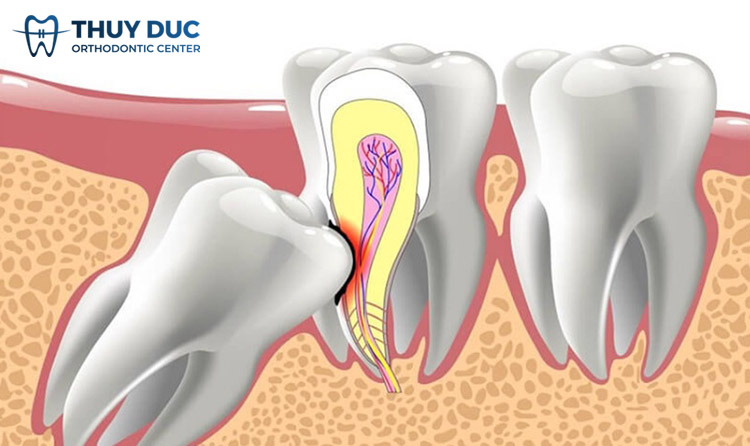 3. Răng khôn mọc lệch có thể gây biến chứng gì? 1 3. Răng khôn mọc lệch có thể gây biến chứng gì? 1