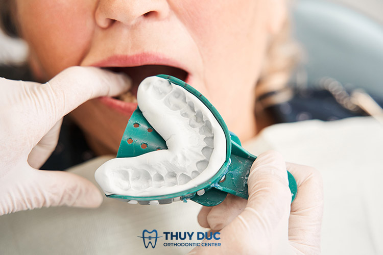 Lấy dấu răng trực tiếp bằng thạch cao, bột lấy dấu răng Alginate 1 Lấy dấu răng trực tiếp bằng thạch cao, bột lấy dấu răng Alginate 1