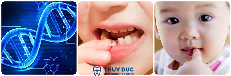 2/ Nguyên nhân dẫn đến tình trạng răng xấu 1