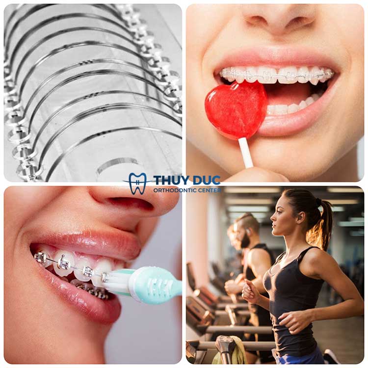 3. Những nguyên nhân dẫn tới bung tuột dây cung 1