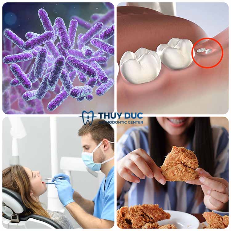 1. Nguyên nhân dẫn đến nhổ răng xong bị sốt 1 1. Nguyên nhân dẫn đến nhổ răng xong bị sốt 1