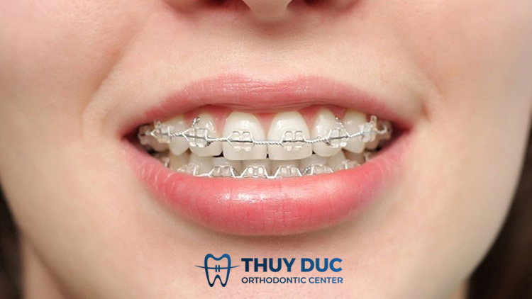 Niềng răng 1 Niềng răng 1
