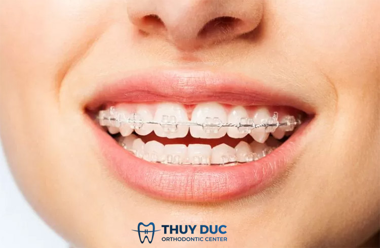 Niềng răng 2