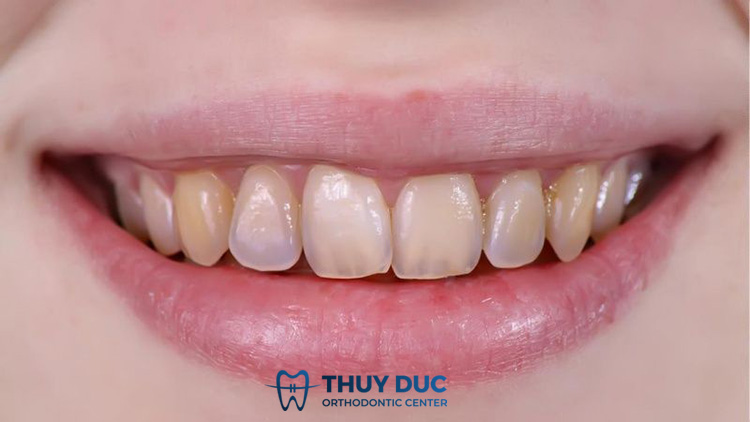 Răng xỉn màu, ố vàng 1 Răng xỉn màu, ố vàng 1