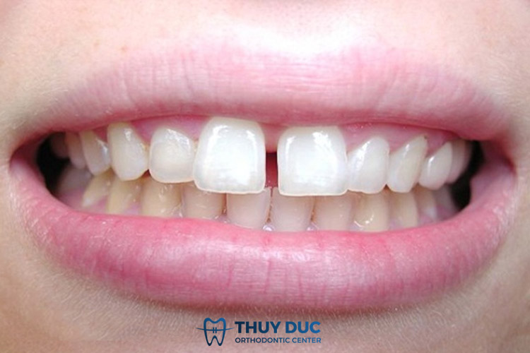 Răng cửa thưa, to 1 Răng cửa thưa, to 1