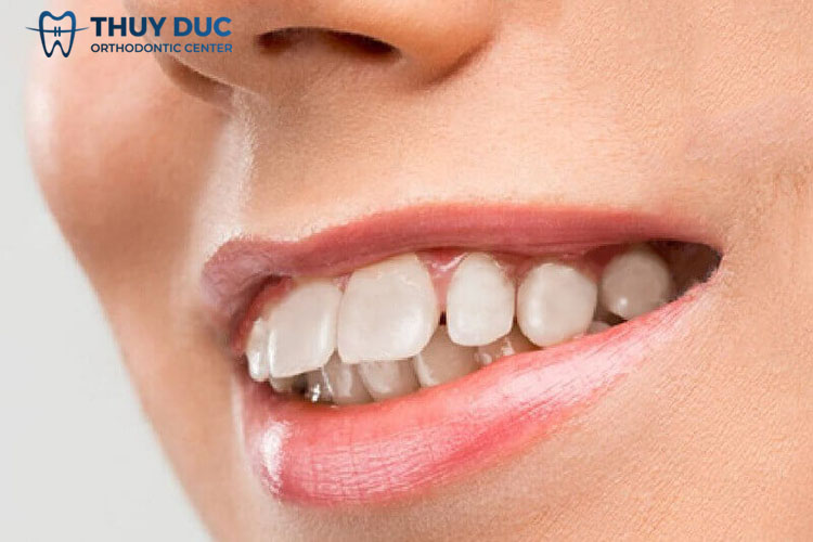 Răng khấp khểnh, hô vẩu 1 Răng khấp khểnh, hô vẩu 1