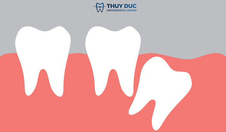 2. Răng khôn mọc lệch nhưng không đau có cần nhổ không? 1 2. Răng khôn mọc lệch nhưng không đau có cần nhổ không? 1