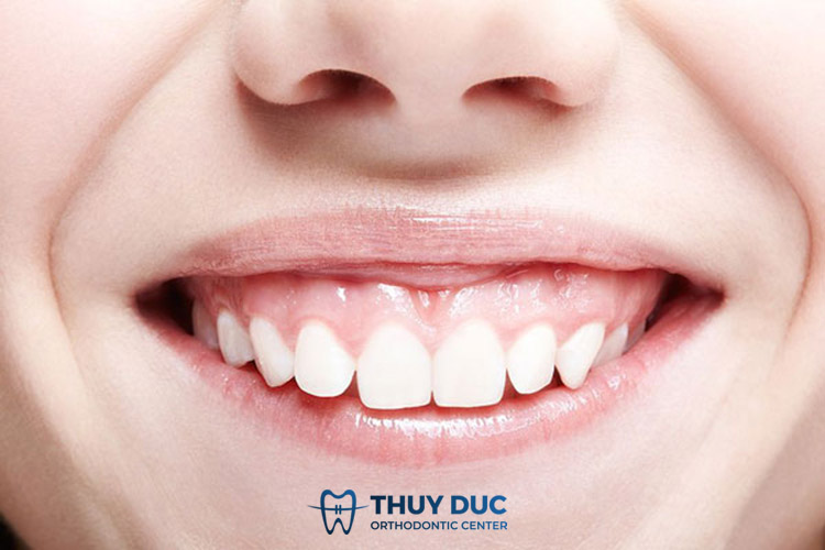 Răng ngắn, móm, cười hở lợi 1 Răng ngắn, móm, cười hở lợi 1