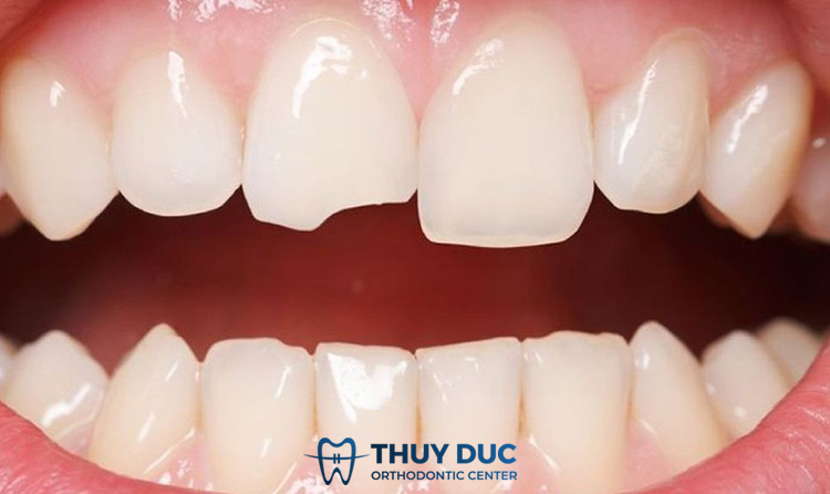 Răng sứt mẻ, mất răng 1 Răng sứt mẻ, mất răng 1