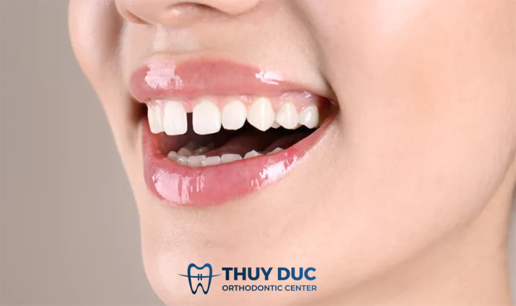 Răng thưa 1