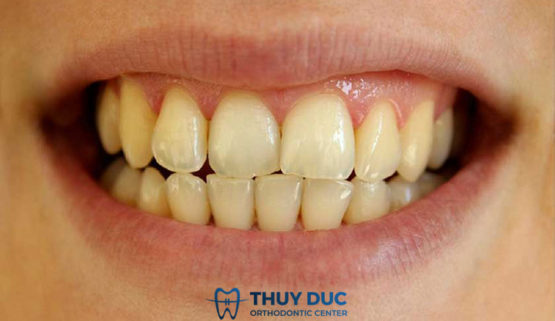 Như thế nào là hàm răng xấu? Cách cải thiện hàm răng xấu hiệu quả