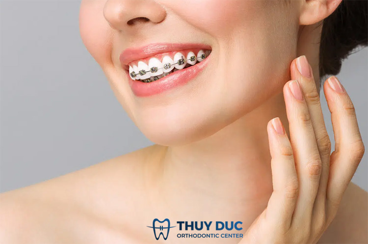 Sau khi tháo niềng răng có bị “chạy” lại vị trí cũ không? 1 Sau khi tháo niềng răng có bị “chạy” lại vị trí cũ không? 1