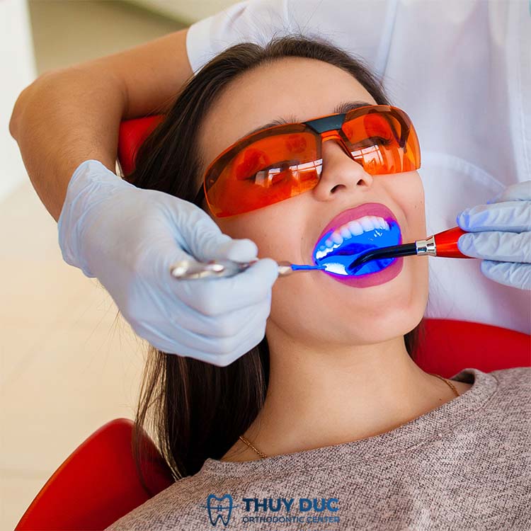 Tẩy trắng răng 1