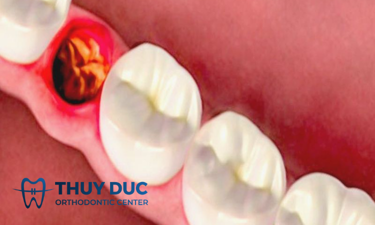 Dấu hiệu nhiễm trùng sau khi nhổ răng khôn? 1 Dấu hiệu nhiễm trùng sau khi nhổ răng khôn? 1
