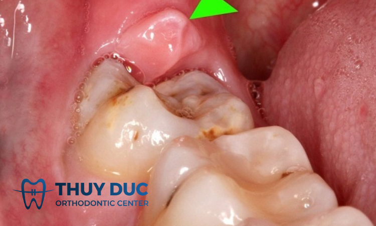 Nướu xung quanh vị trí nhổ răng bị sưng tấy 1 Nướu xung quanh vị trí nhổ răng bị sưng tấy 1