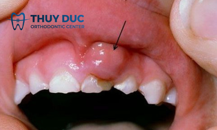 Lợi bị chảy máu và sưng tấy 1