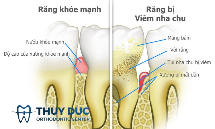 Bệnh nha chu là gì? 1