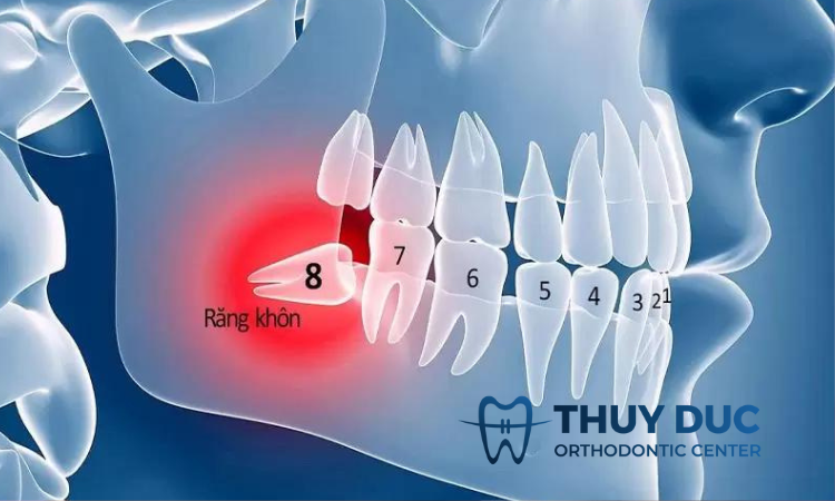 Nếu chỉ nhổ răng khôn hàm dưới 1 Nếu chỉ nhổ răng khôn hàm dưới 1