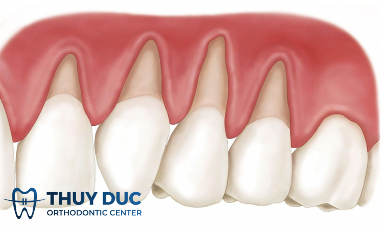 Bệnh viêm nha chu có nguy hiểm không? 1