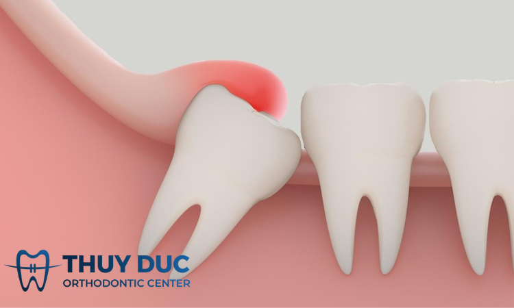 Có nên nhổ răng khôn hàm trên không? 1 Có nên nhổ răng khôn hàm trên không? 1