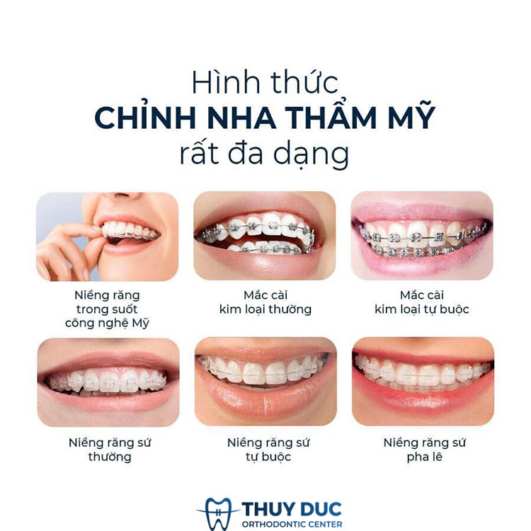 Niềng răng thẩm mỹ 1 Niềng răng thẩm mỹ 1