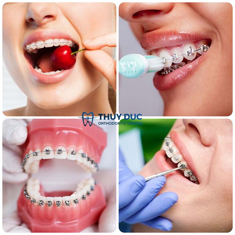 1. Những nguyên nhân gây bung sút mắc cài niềng răng 1