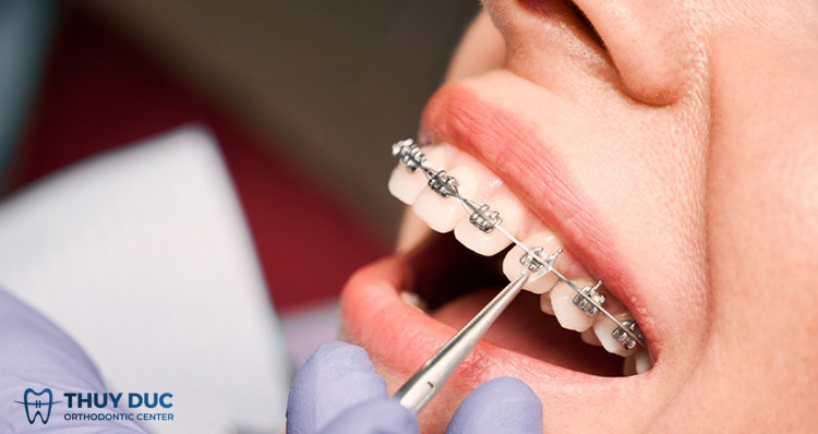 4. Niềng răng xong có bị hô trở lại không? 1 4. Niềng răng xong có bị hô trở lại không? 1