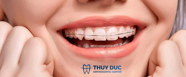 2. Niềng răng là gì? 1