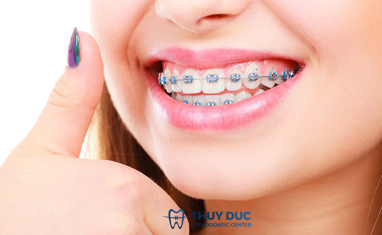 Niềng răng mắc cài kim loại 1 Niềng răng mắc cài kim loại 1