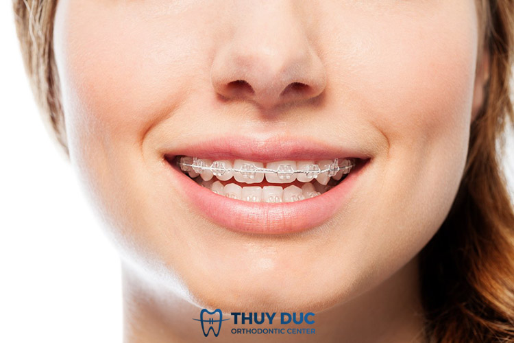 Niềng răng thẩm mỹ 3 Niềng răng thẩm mỹ 3