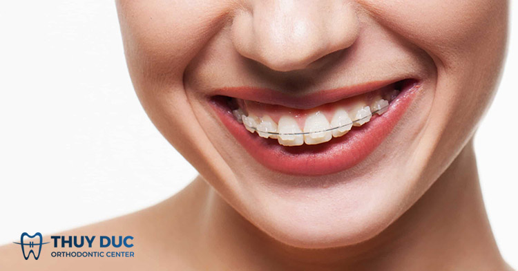 Niềng răng mắc cài sứ 1 Niềng răng mắc cài sứ 1