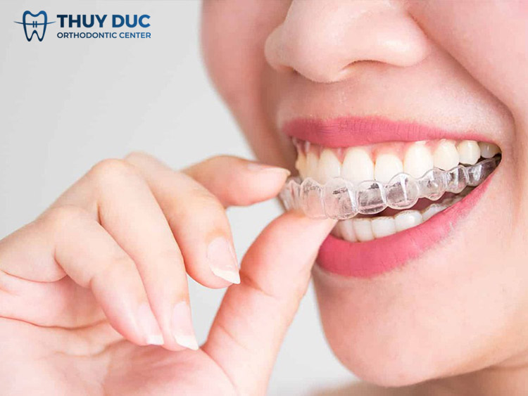 Niềng răng trong suốt Invisalign 1 Niềng răng trong suốt Invisalign 1