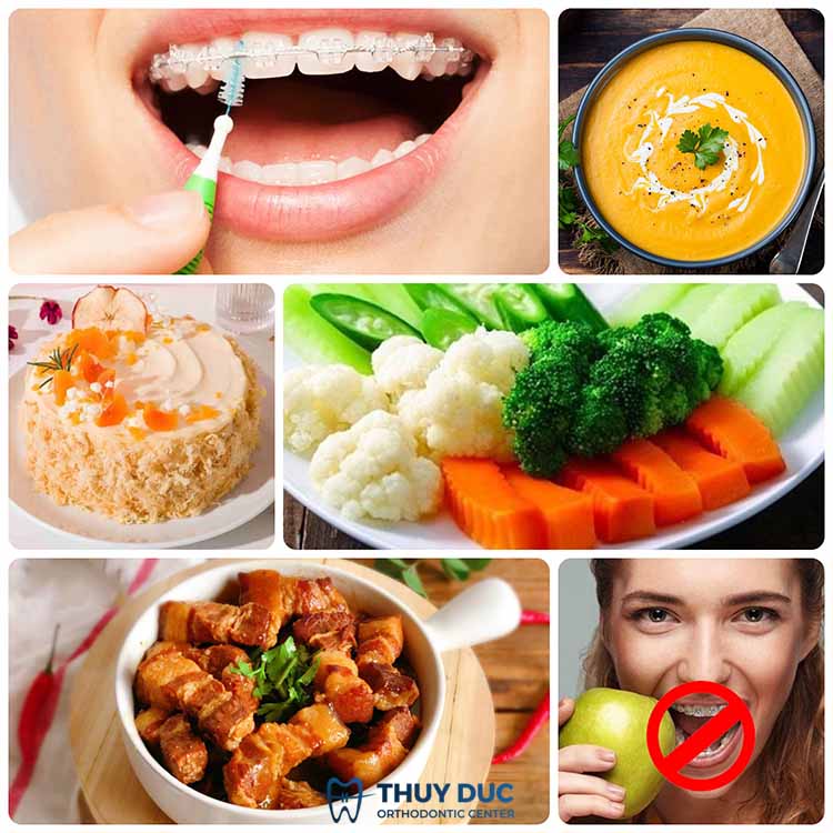 4. Hướng dẫn cách phòng tránh bung sút mắc cài niềng răng 1