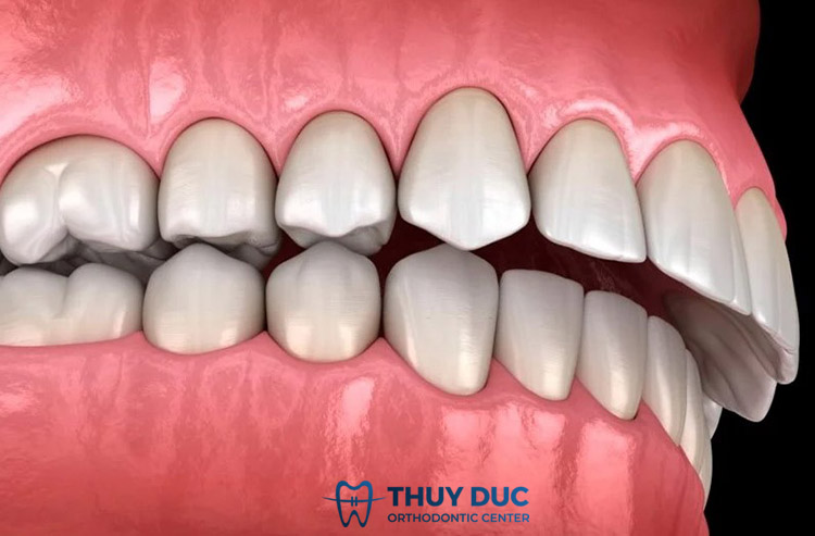 Răng hô là gì? 1 Răng hô là gì? 1