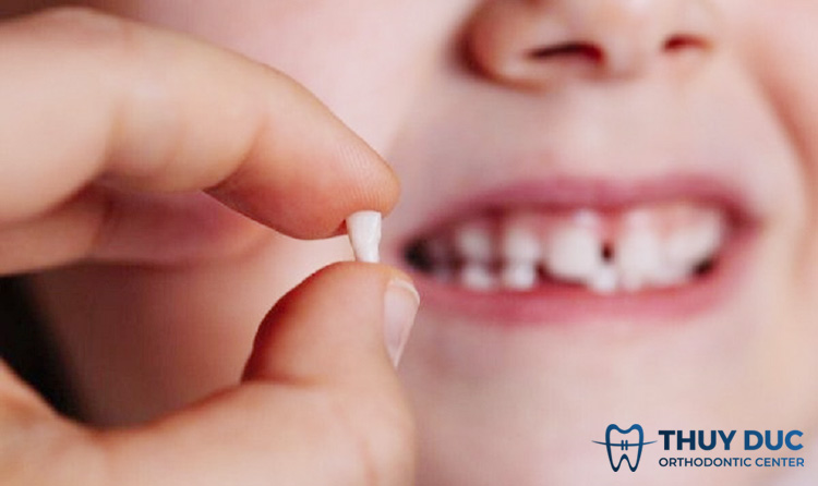 1. Thời điểm thay răng sữa của trẻ 1