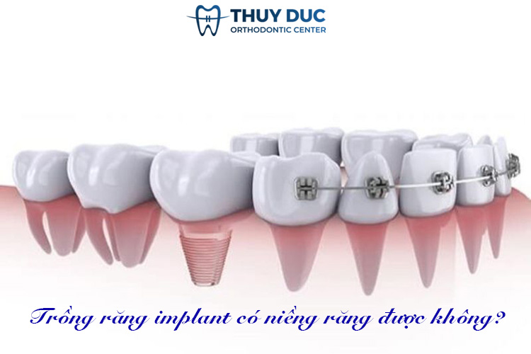 3. Trồng răng implant có niềng răng được không? 1