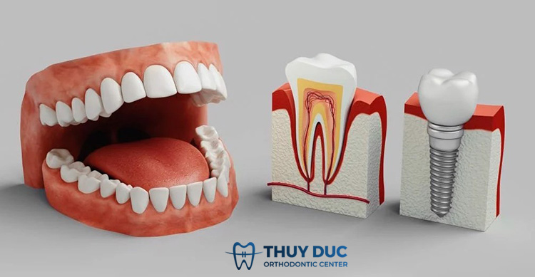 1. Trồng răng implant là gì? 1