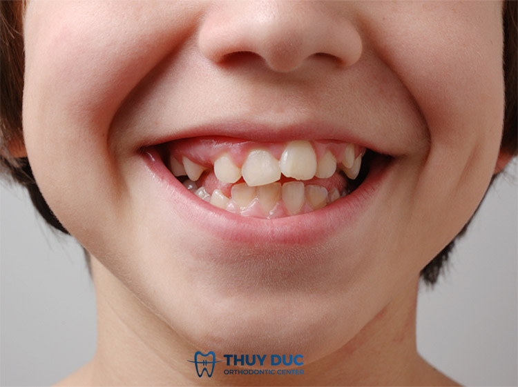 3. Những ảnh hưởng khi răng bị mọc lệch 1