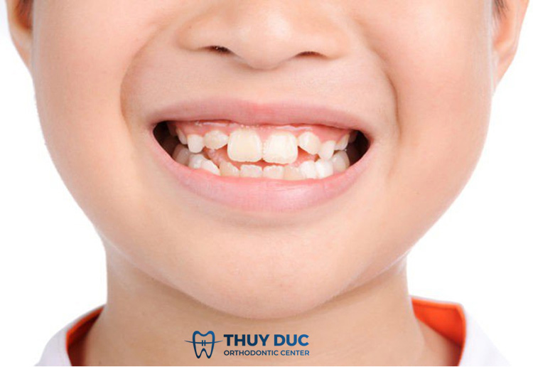 1. Dấu hiệu nhận biết bé thay răng bị mọc lệch 1