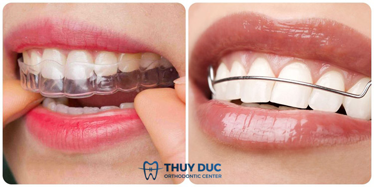 Đeo hàm duy trì sau khi niềng răng, chỉnh nha 1 Đeo hàm duy trì sau khi niềng răng, chỉnh nha 1