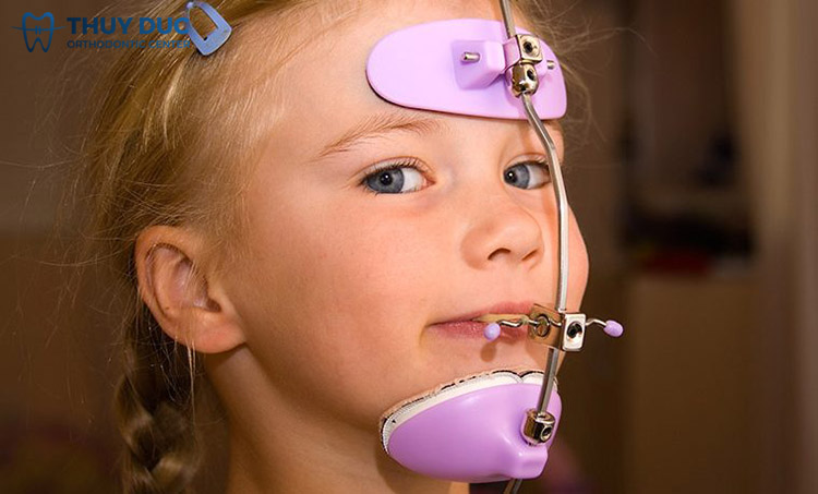 Đeo hàm facemask 1