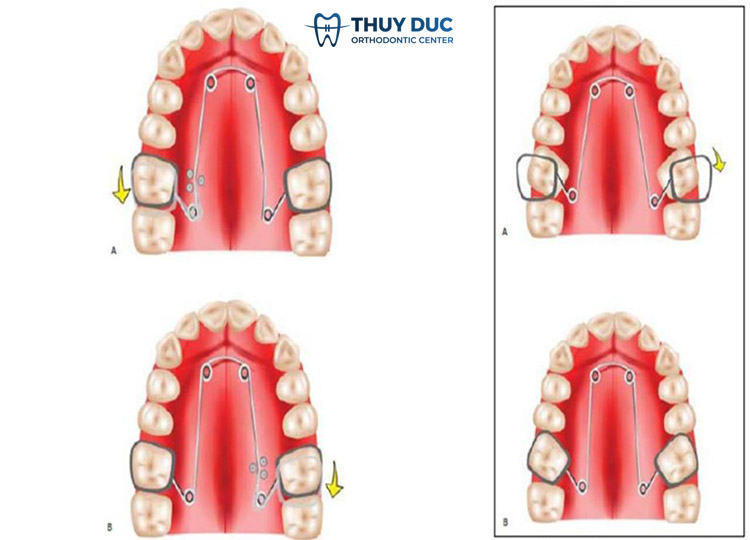 Sử dụng khí cụ cố định 2