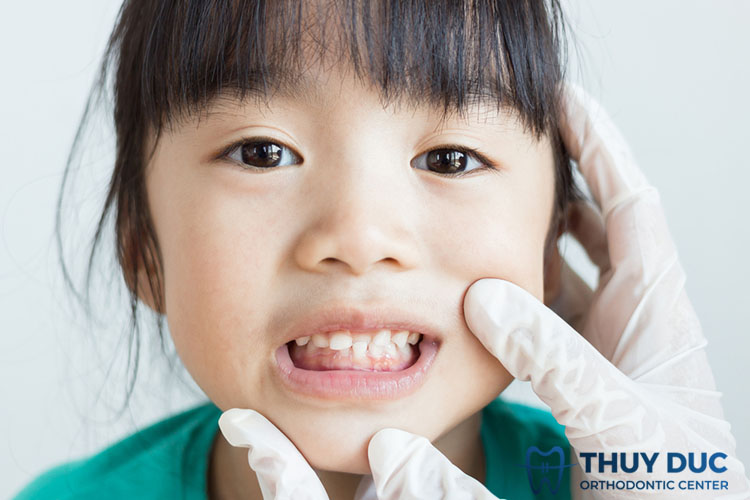 1. Khớp cắn ngược là gì? 1