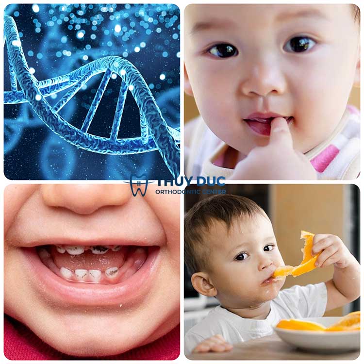 2. Nguyên nhân dẫn tới răng bị mọc lệch ở bé 1