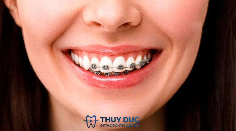 2. Niềng răng giữ lại răng khểnh có được không? 1