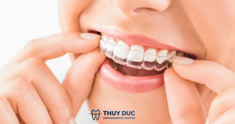 Niềng răng trong suốt Invisalign 1