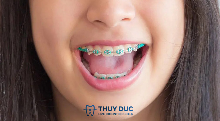 Niềng răng mắc cài 1